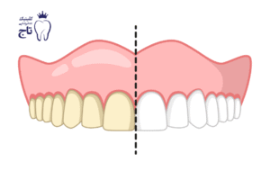 بلیچینگ دندان در خانه