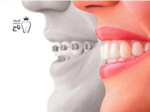 لمینت یا ارتودنسی؟ انتخاب بین زیبایی فوری یا درمانی بلندمدت