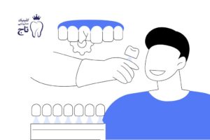 مراحل کامپوزیت