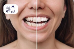 کامپوزیت برای دندان های کج