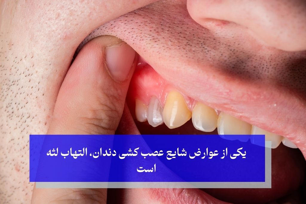 یکی از عوارض شایع عصب کشی دندان، التهاب لثه است