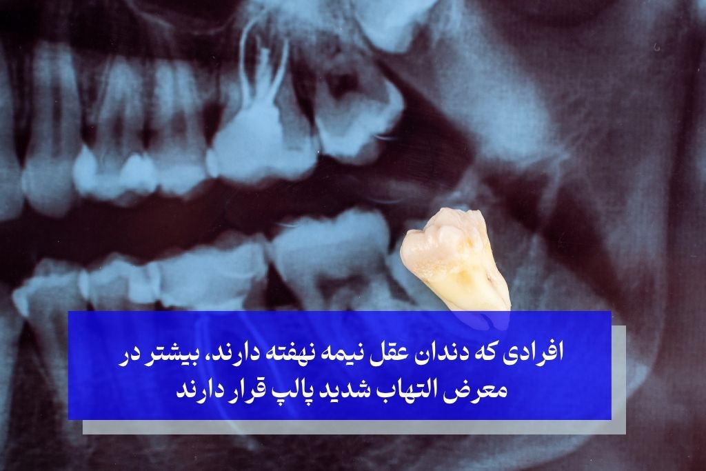 افرادی که دندان عقل نیمه نهفته دارند، بیشتر در معرض التهاب شدید پالپ قرار دارند