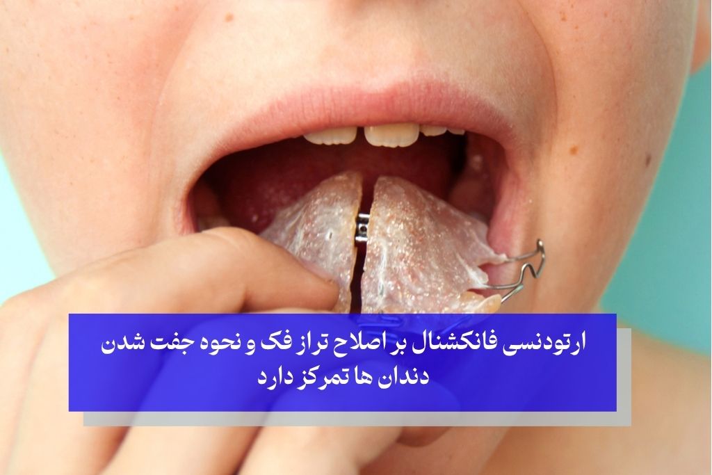 ارتودنسی فانکشنال چیست