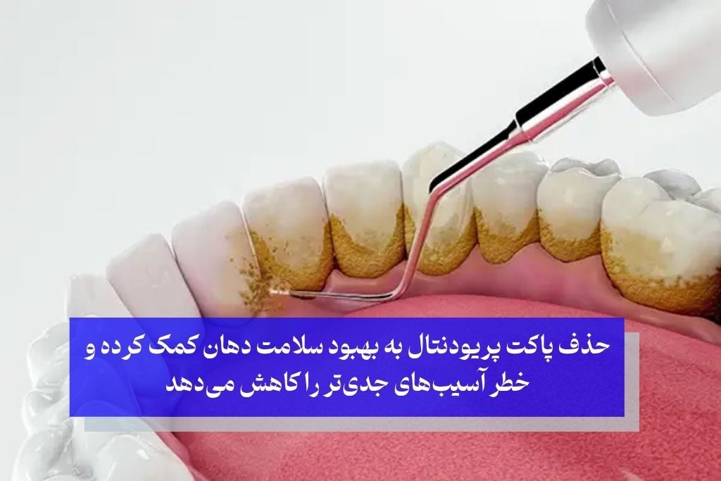 درمان سوراخ‌ لثه