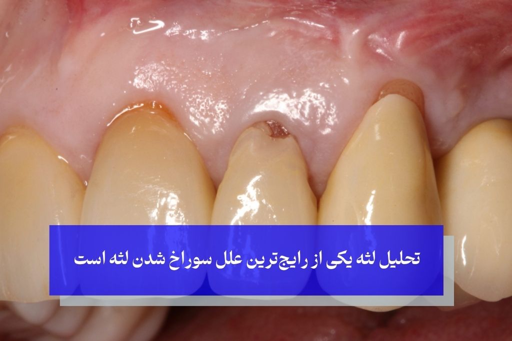 رایج‌ترین علل سوراخ شدن لثه