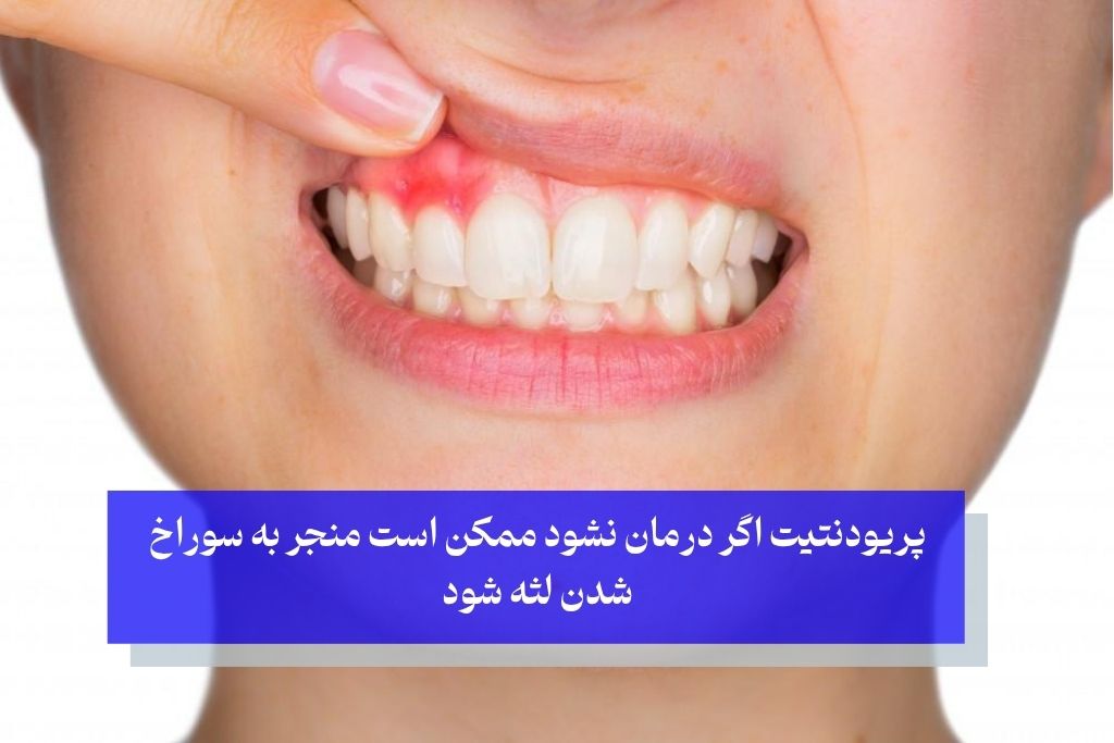 علت سوراخ شدن لثه