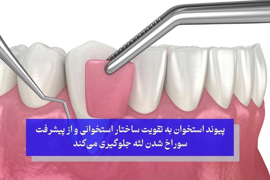 پیوند استخوان