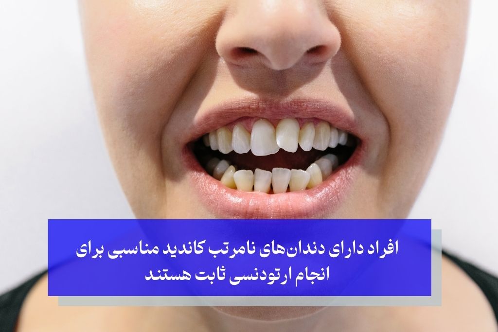 افراد دارای دندانهای نامرتب کاندید مناسبی برای انجام ارتودنسی ثابت هستند