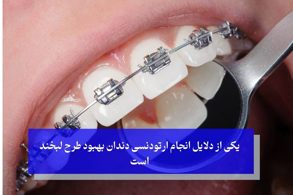 یکی از دلایل انجام ارتودنسی دندان بهبود طرح لبخند است