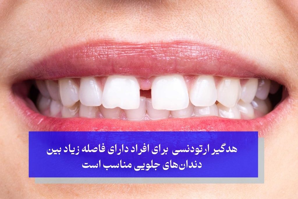 هدگیر ارتودنسی برای افراد دارای فاصله زیاد بین دندانهای جلویی مناسب است
