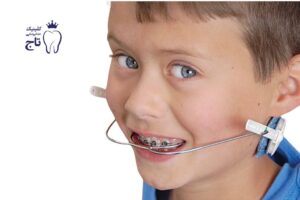 هدگیر ارتودنسی