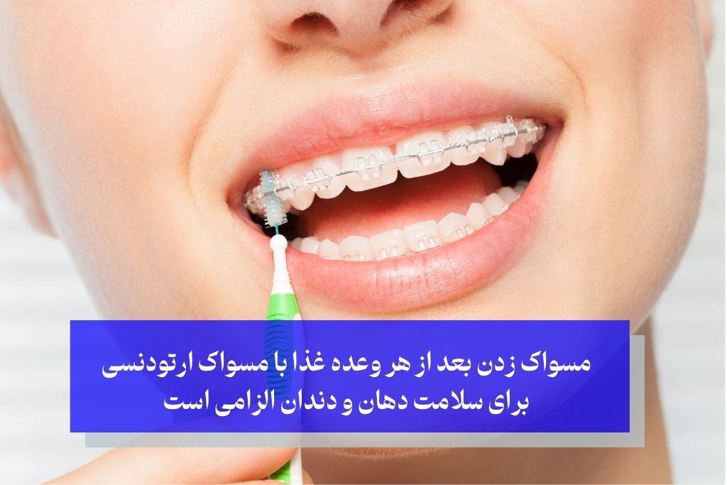 مسواک زدن بعد از هر وعده غذا با مسواک ارتودنسی برای سلامت دهان و دندان الزامی است