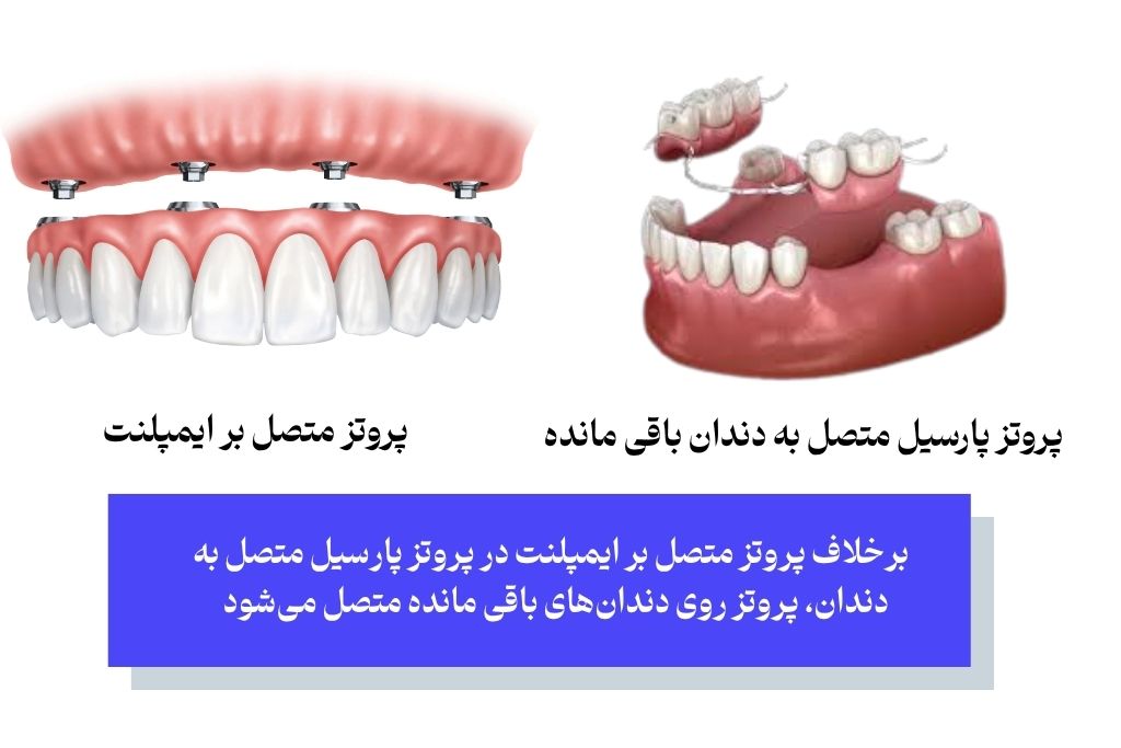 برخلاف پروتز متصل بر ایمپلنت در پروتز پارسیل متصل به دندان، پروتز روی دندان‌های باقی مانده متصل می‌شود 