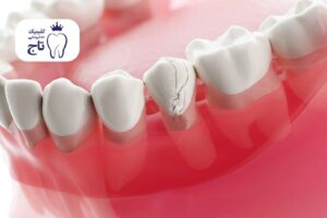 ترومای دندان