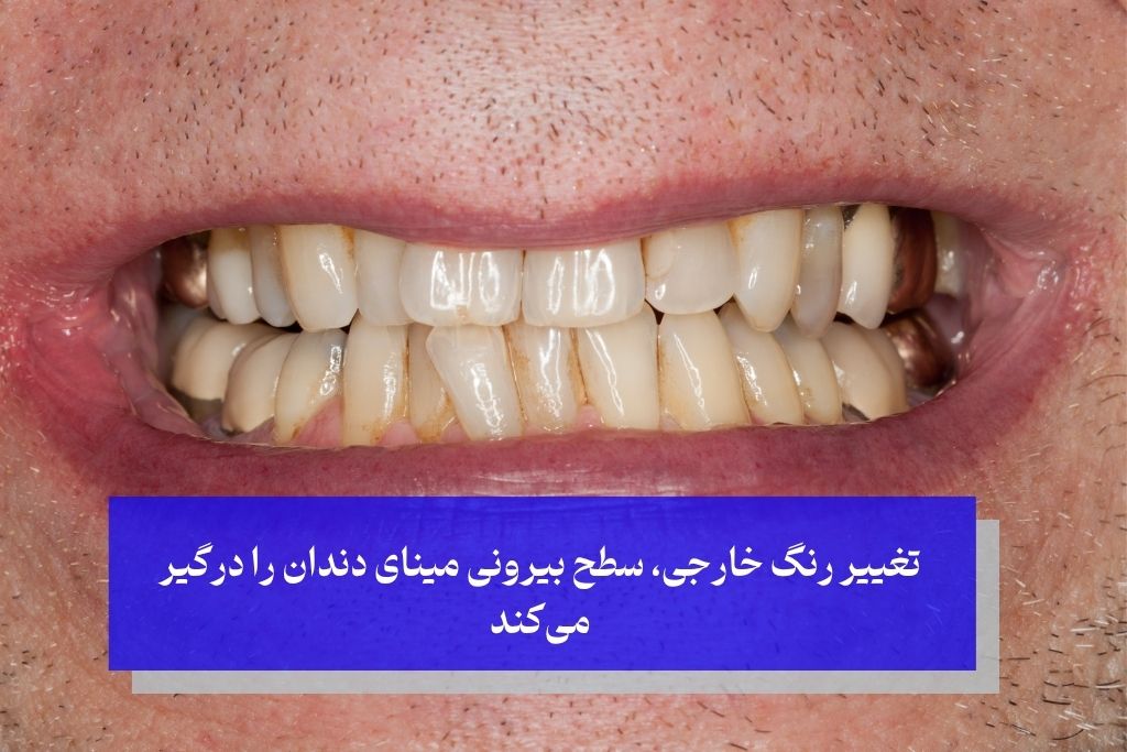 دلایل خارجی سیاه شدن دندان