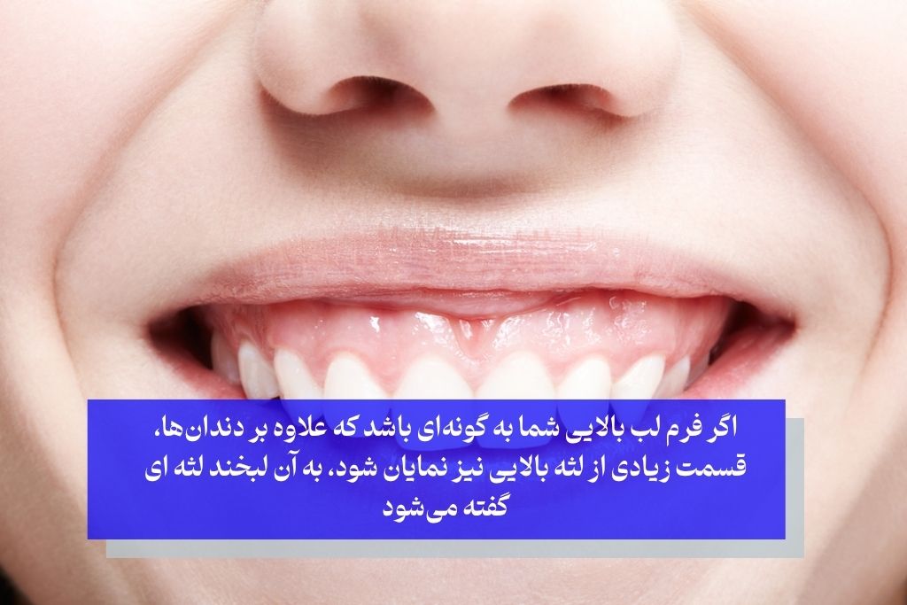 لبخند لثه ای چیست