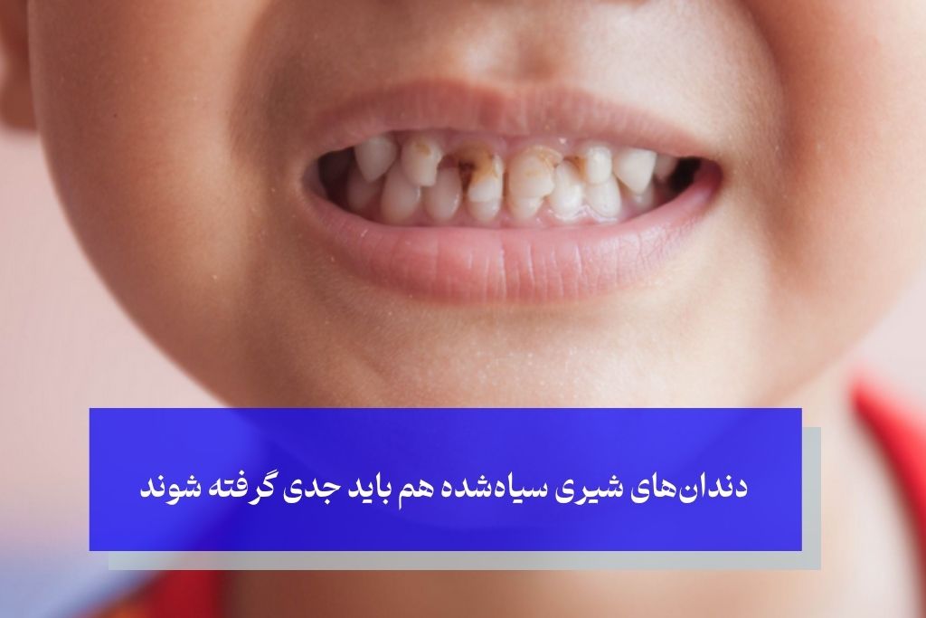 کودکان و سیاه شدن دندان؛ چرا باید بیشتر نگران باشیم؟