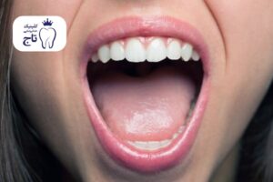 علت زیاد شدن بزاق دهان