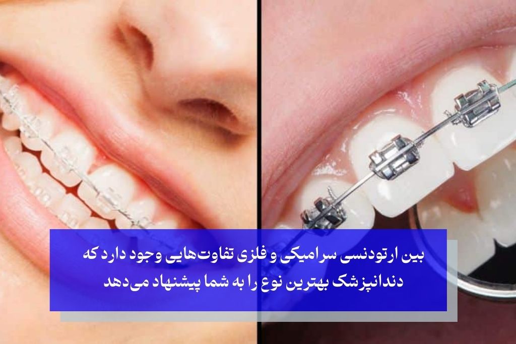 ارتودنسی سرامیکی بهتر است یا فلزی