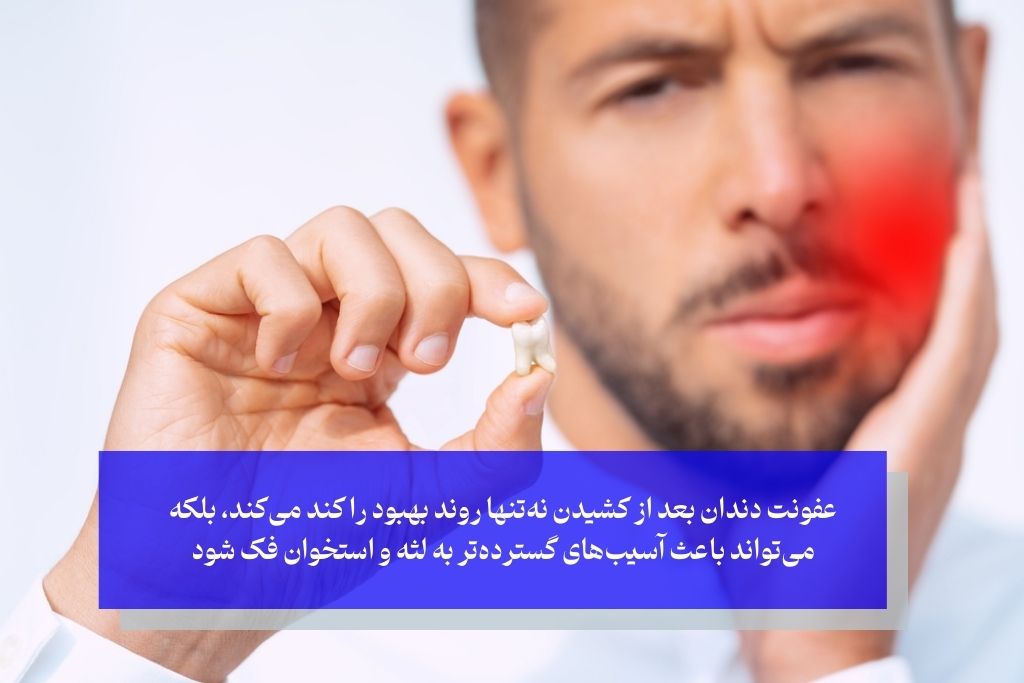 عفونت دندان بعد از کشیدن چیست