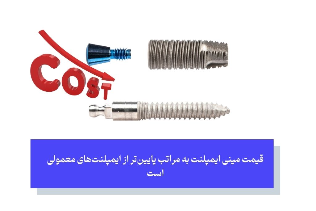 قیمت و هزینه مینی ایمپلنت