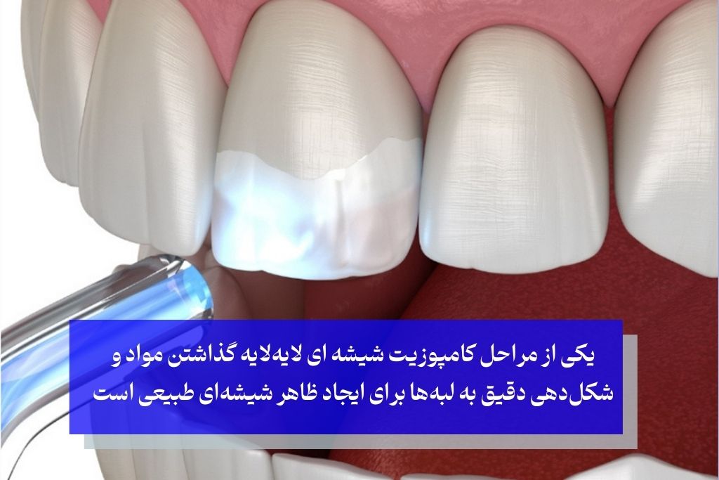 مراحل انجام کامپوزیت شیشه‌ای