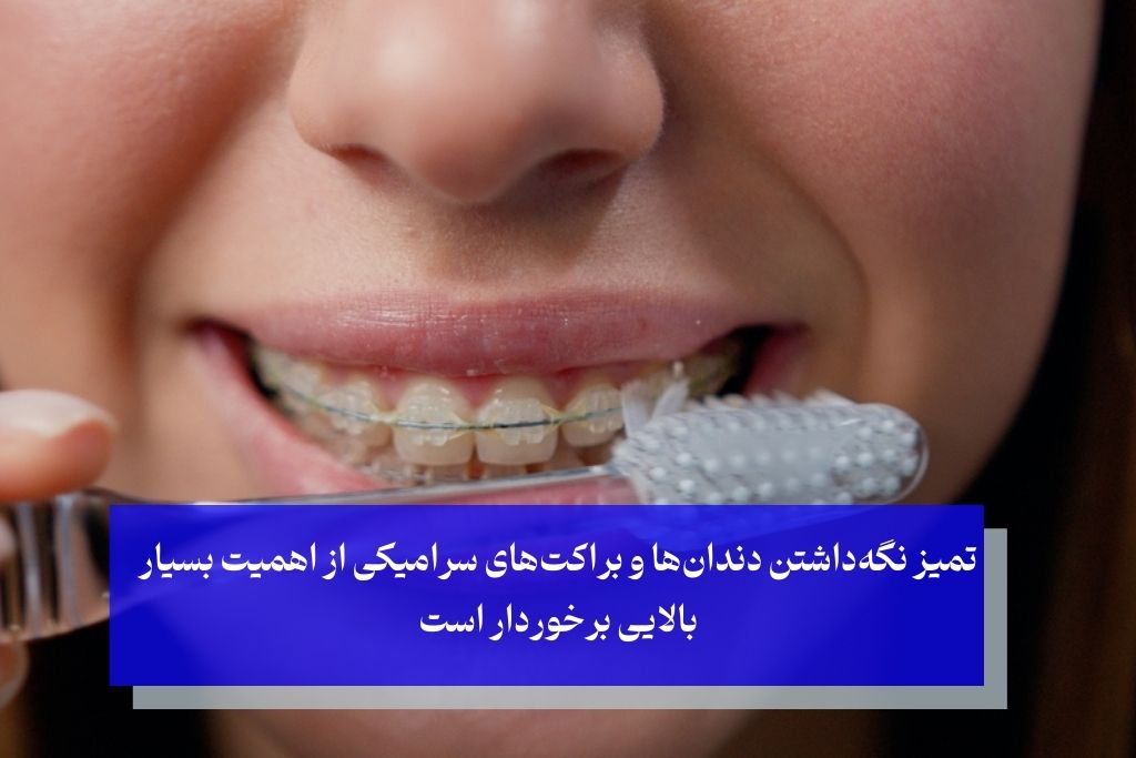 مراقبت‌های ضروری در ارتودنسی سرامیکی