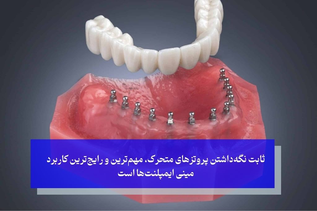 کاربردهای اصلی مینی ایمپلنت