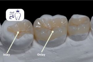 اینله و آنله دندان