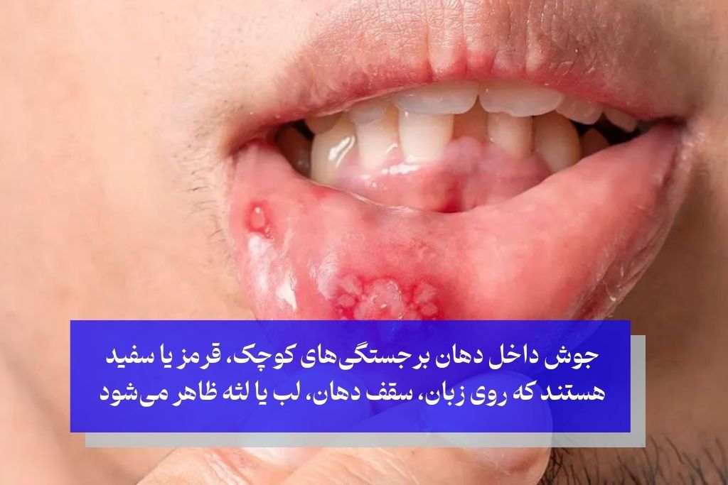 تفاوت جوش داخل دهان با دیگر مشکلات