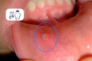 جوش داخل دهان