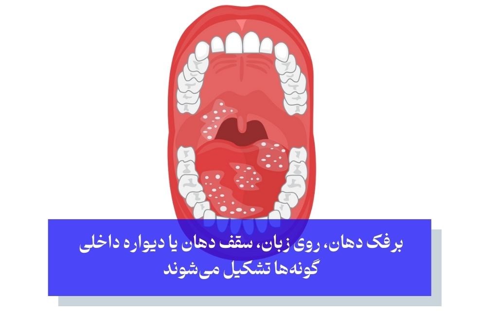 جوش داخل دهان و برفک دهان