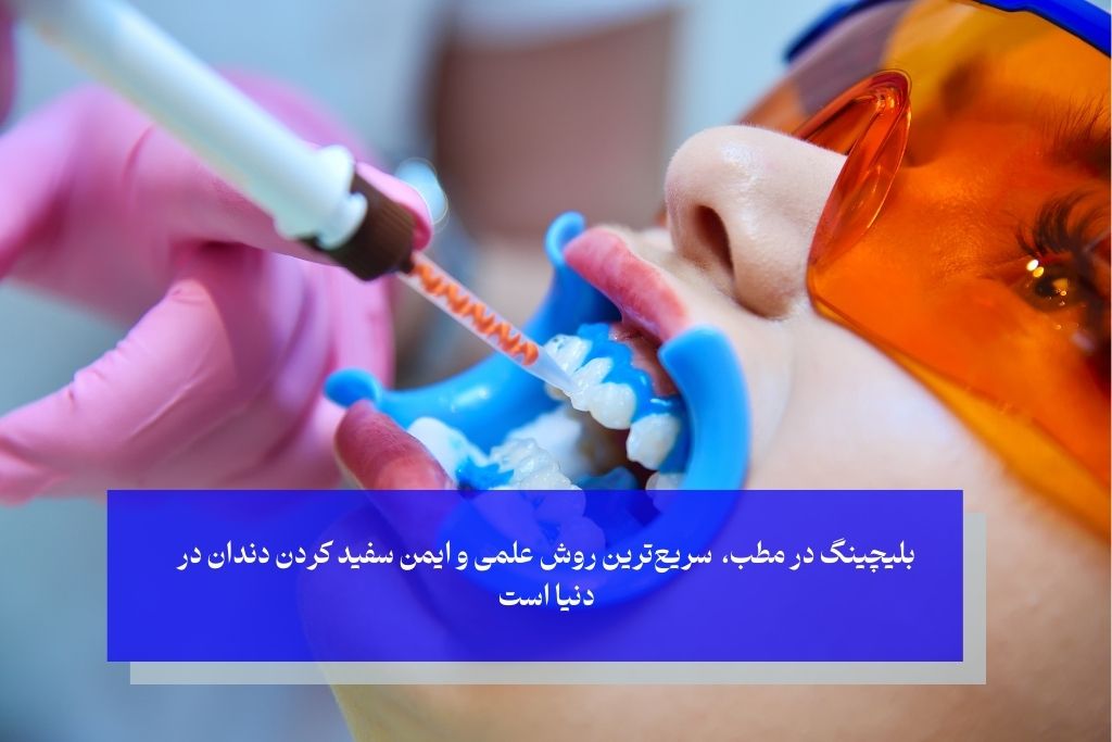 درمان‌های تخصصی سفید کردن دندان بهترین گزینه هستند