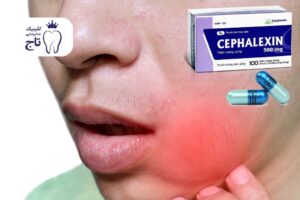 سفالکسین برای عفونت دندان