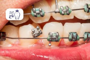 شکستن براکت و سیم ارتودنسی