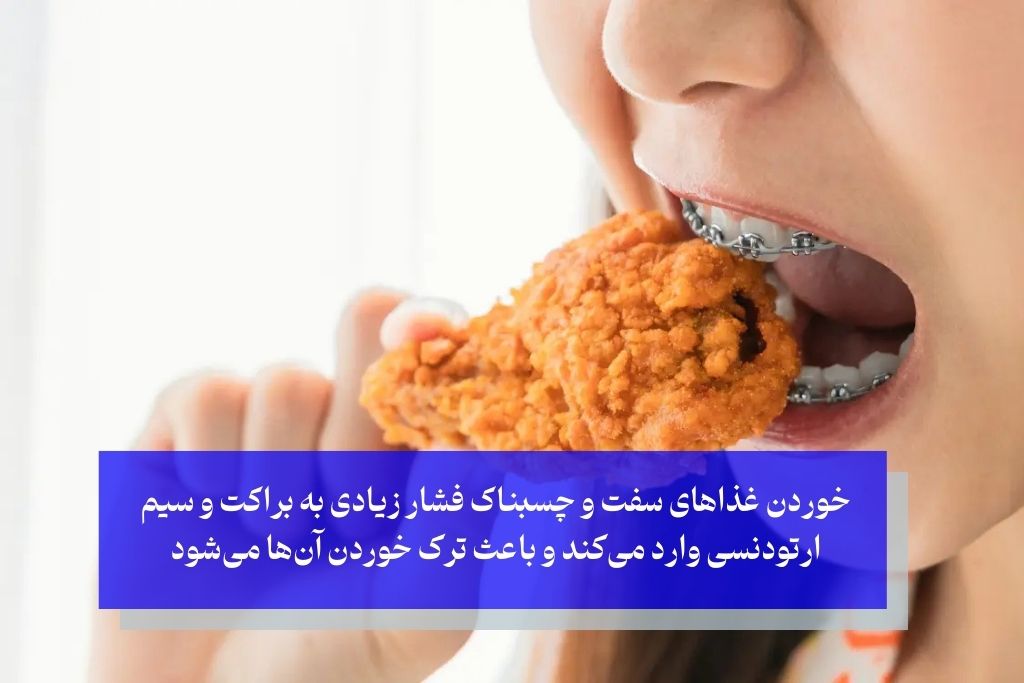 شکستن براکت و سیم ارتودنسی به علت غذا