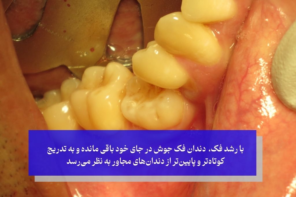 علائم و تشخیص دندان فک جوش