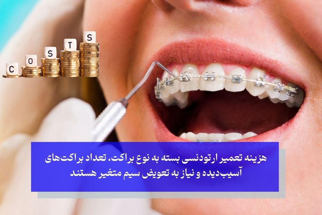 هزینه تعمیر شکستن براکت و سیم ارتودنسی