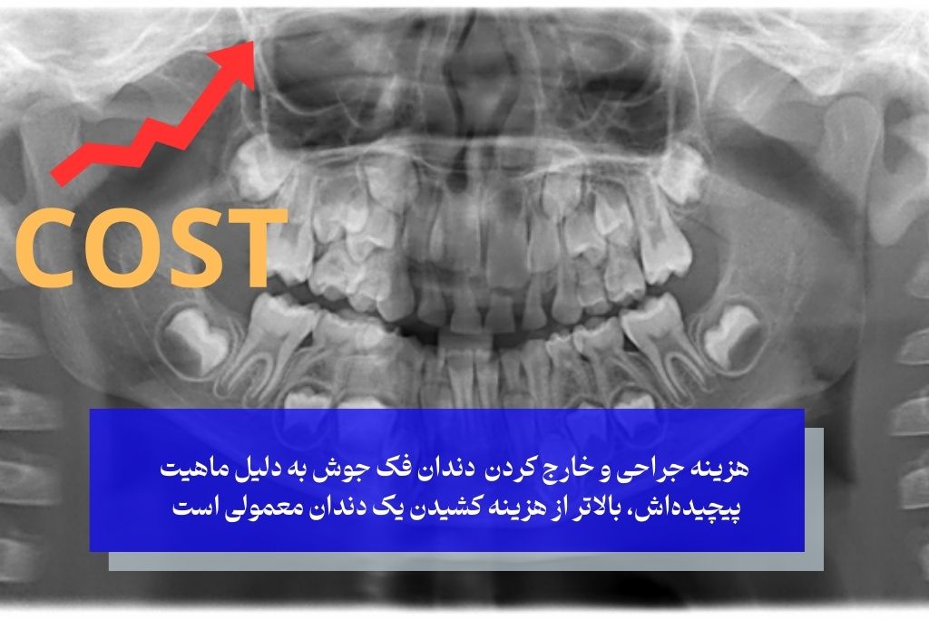 هزینه جراحی دندان فک جوش در سال ۱۴۰۴