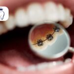 ارتودنسی لینگوال