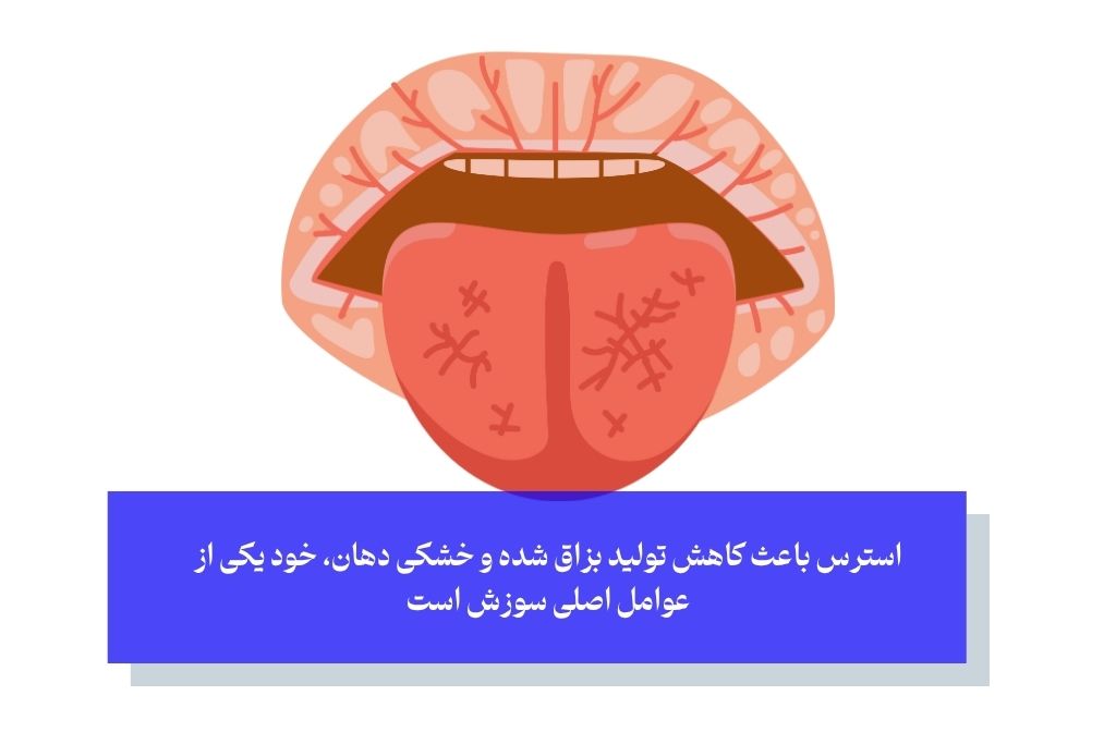 استرس و سوزش زبان؛ بررسی ارتباط قدرتمند ذهن و بدن
