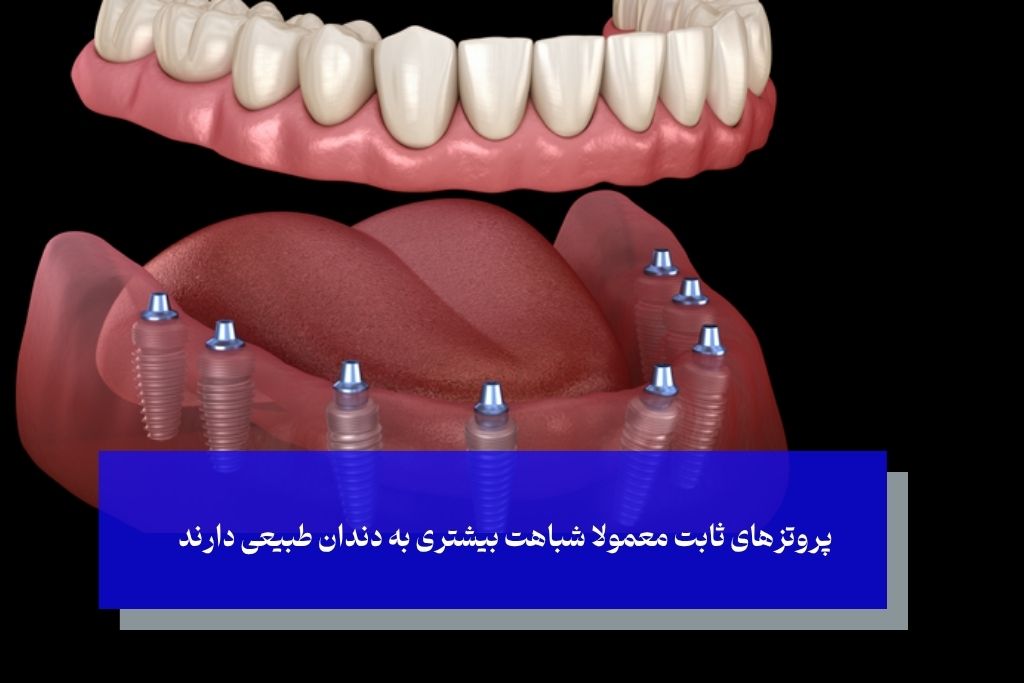 تفاوت‌های کلیدی دندان مصنوعی ثابت و متحرک