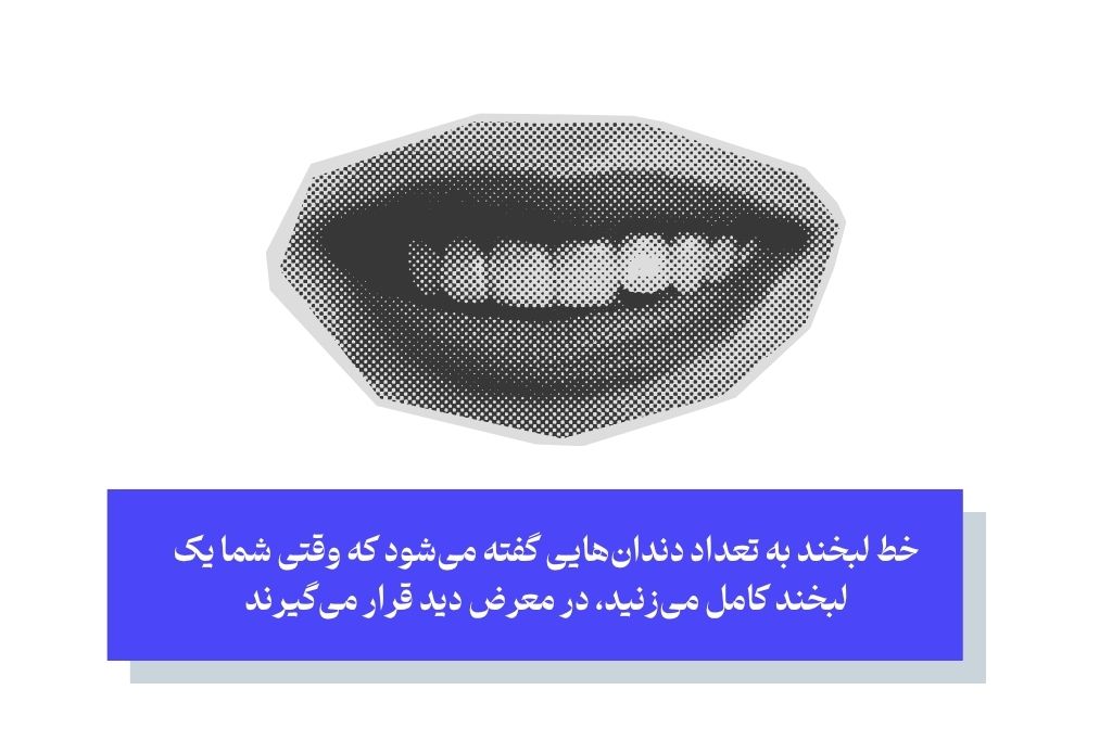 خط طرح لبخند (Smile Line) چیست و چند واحد دندان را شامل می‌شود