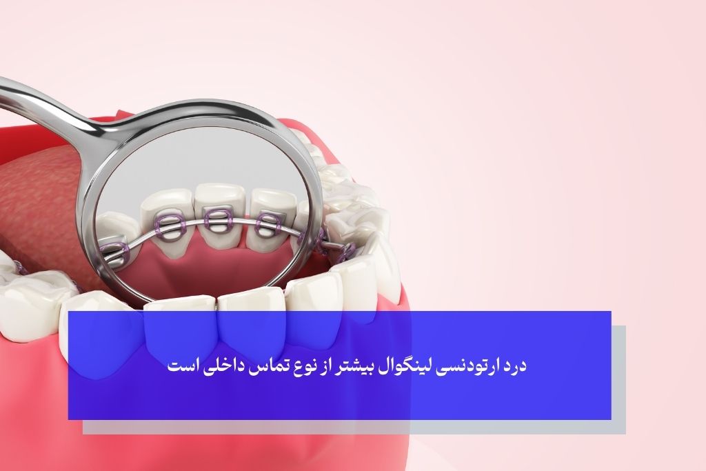 درد و ناراحتی در ارتودنسی لینگوال؛ واقعیت یا بزرگ‌نمایی؟