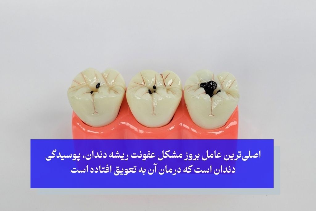 دلایل اصلی نفوذ عفونت به ریشه