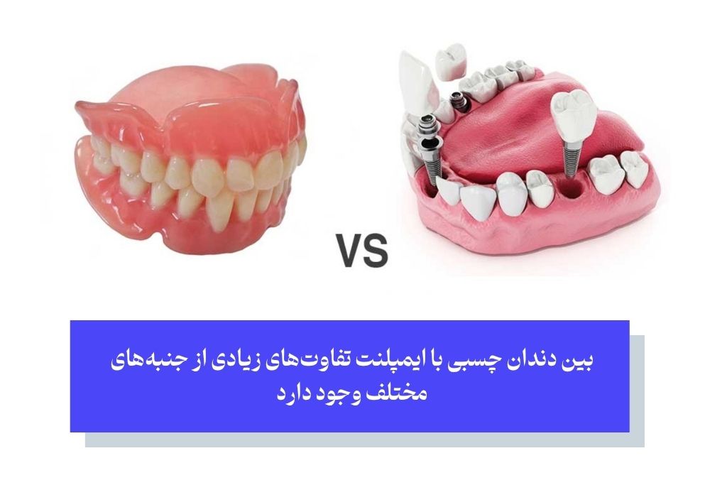 دوئل دندان چسبی بهتر است یا ایمپلنت