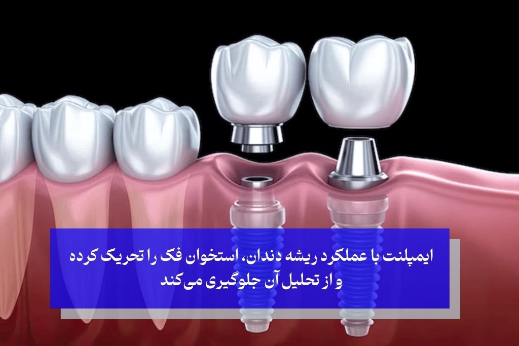 زیبایی صورت در دندان چسبی بهتر است یا ایمپلنت؟