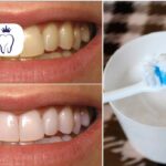 سفید کردن دندان با جوش شیرین