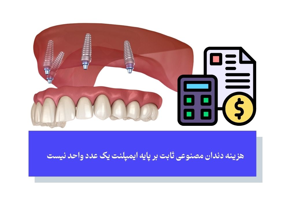 صفر تا صد قیمت دندان مصنوعی ثابت بر پایه ایمپلنت؛ جدول کامل تعرفه‌ها در سال