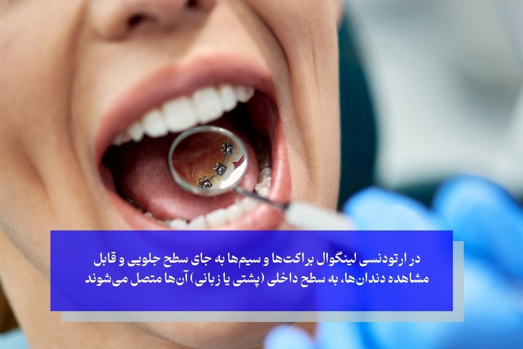 فرآیند درمان با ارتودنسی لینگوال